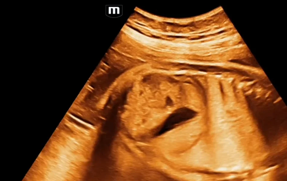 Thận lạc chỗ bắt chéo dính nhau ở thai (Crossed fused renal ectopia)