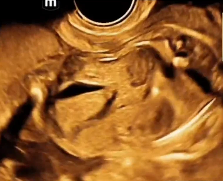 Bất sản thận hai bên thai nhi (Bilateral Renal Agenesis)