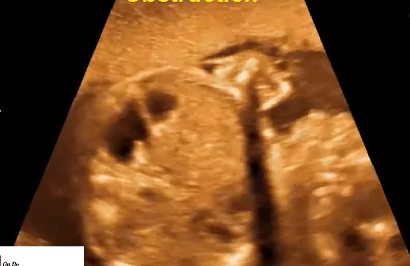 Tắc khúc nối bể thận - niệu quản thai nhi (Ureteropelvic Junction Obstruction - UPJ Obstruction)