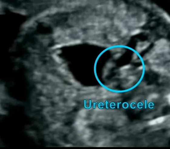 Nang nước tiểu / Tràn dịch quanh thận ở thai (Urinoma)