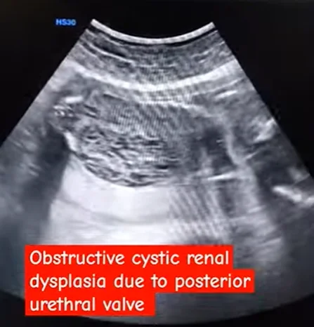 Loạn sản thận do tắc nghẽn ở thai nhi (Obstructive Renal Dysplasia - ORD)