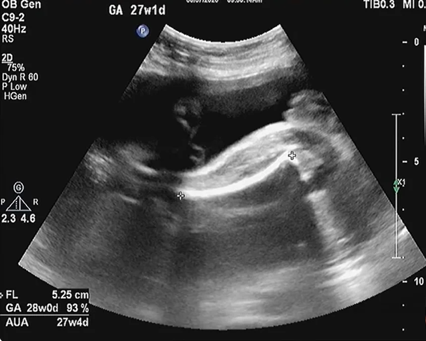 Thận loạn sản đa nang thai nhi (Multicystic Dysplastic Kidney - MCDK)