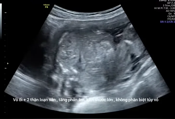 Thận đa nang di truyền lặn thai nhi (Autosomal Recessive Polycystic Kidney Disease - ARPKD)