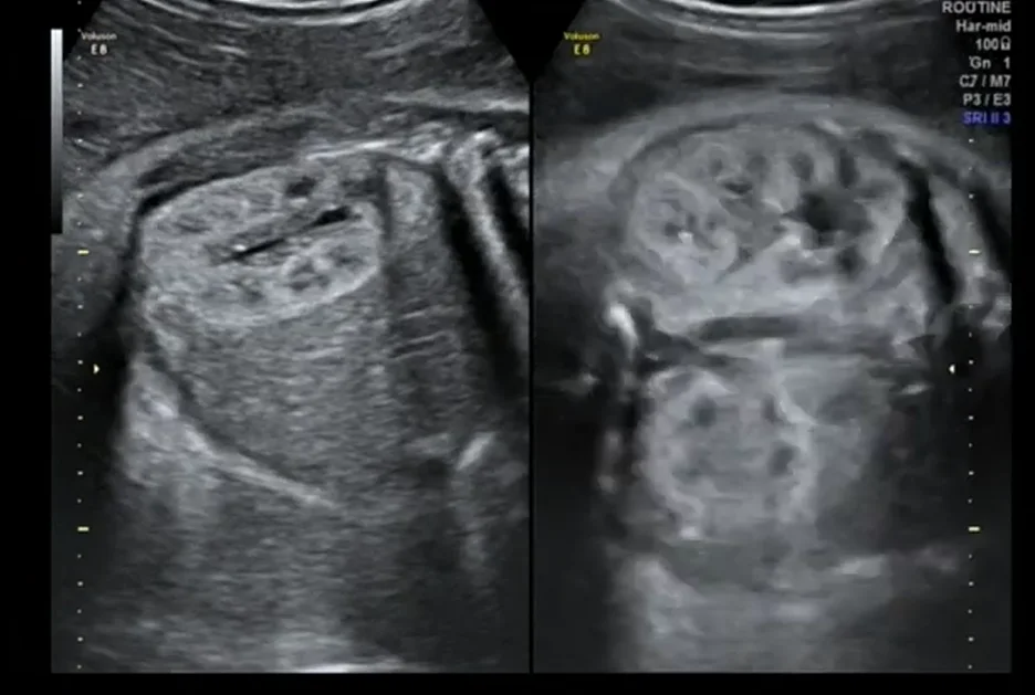 Thận đa nang di truyền trội thai (Autosomal Dominant Polycystic Kidney Disease - ADPKD)