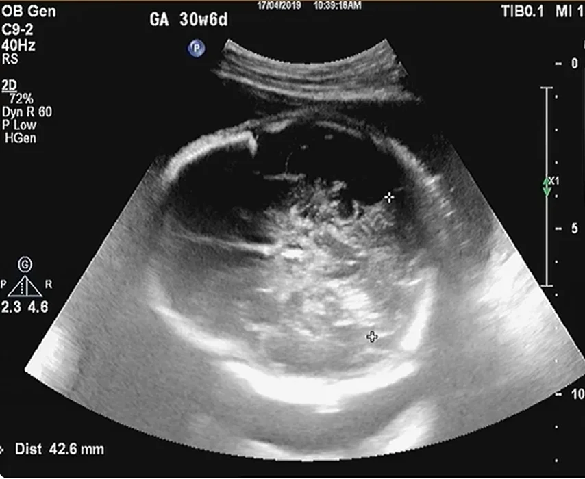 U trung mô thận thai nhi (Mesoblastic Nephroma)