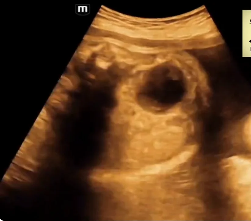 Xuất huyết tuyến thượng thận ở thai nhi (Adrenal Hemorrhage)