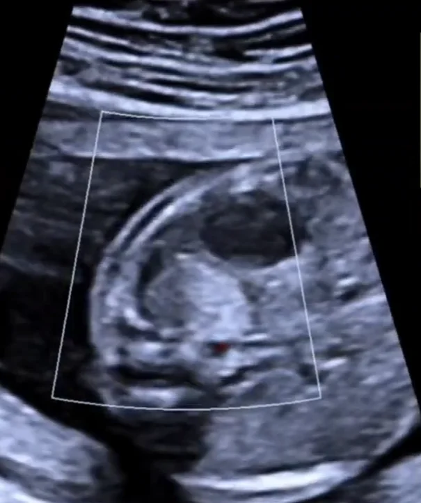 U nguyên bào thần kinh tuyến thượng thận thai nhi (Neuroblastoma)