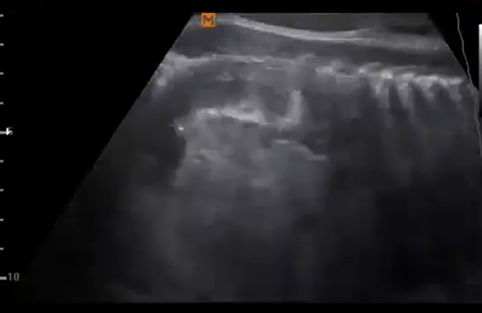 Tăng sản tuyến thượng thận bẩm sinh (Congenital Adrenal Hyperplasia)