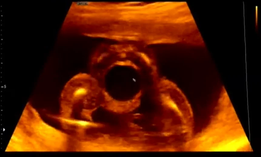 Van niệu đạo sau ở thai nhi (Posterior Urethral Valves - PUV)