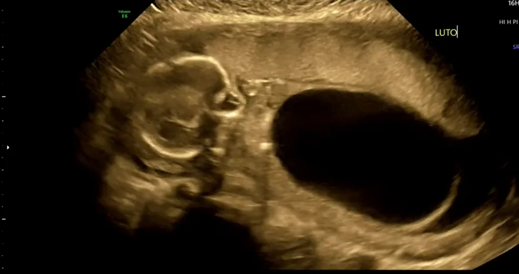 Hội chứng bụng hình quả mận ở thai (Prune-Belly Syndrome)