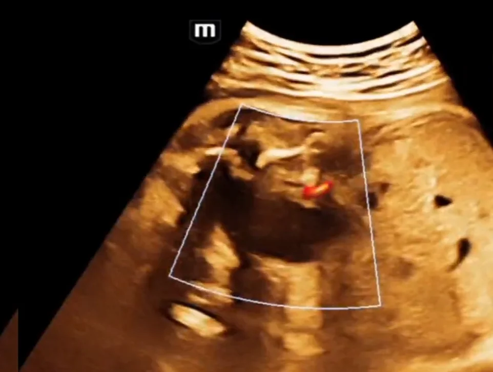 Sa lồi (nang) niệu quản thai nhi (Ureterocele)
