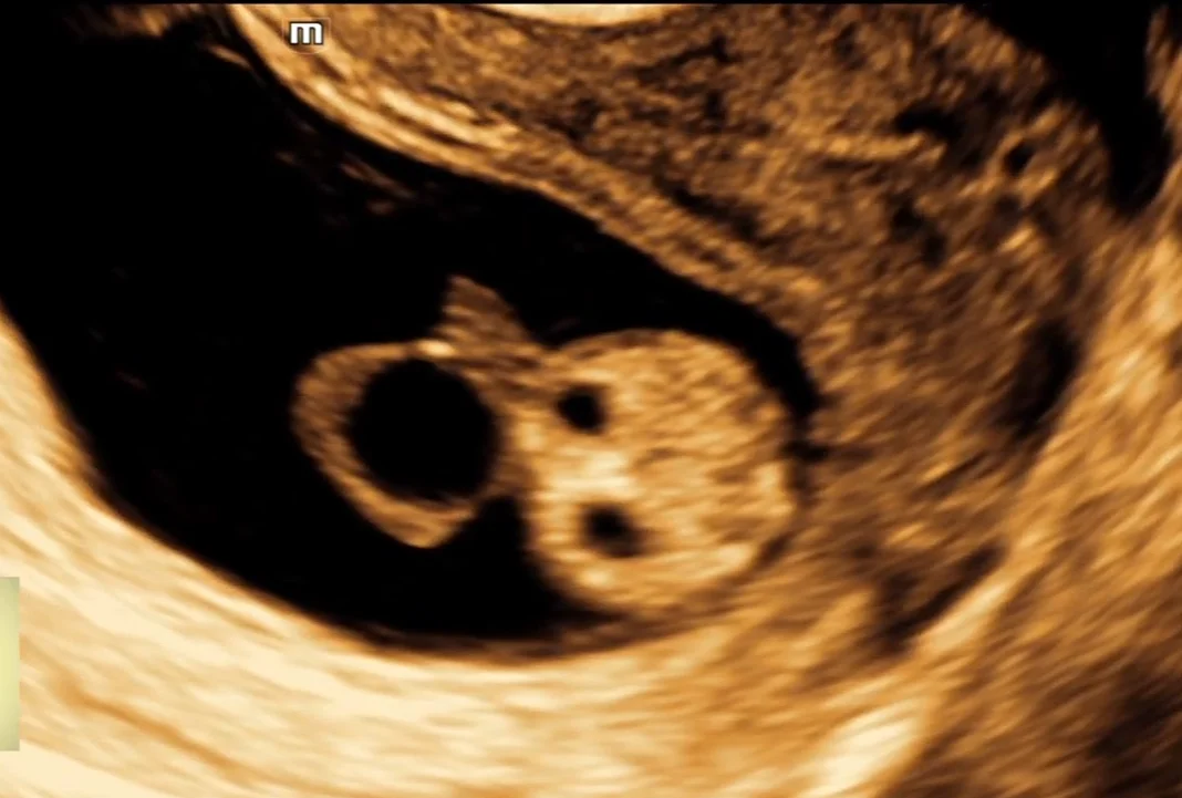 Ống niệu rốn thai nhi (Urachus)