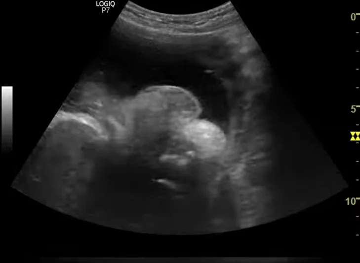 Rối loạn phát triển giới tính ở thai nhi - Disorders of Sex Development (DSD)