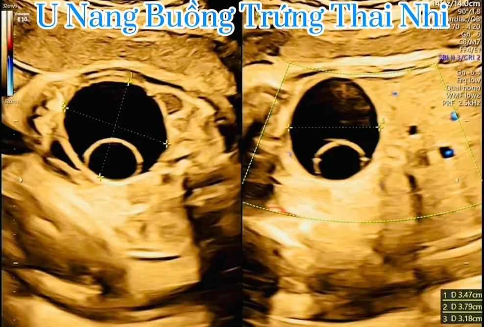 Nang buồng trứng thai nhi (Ovarian Cyst)