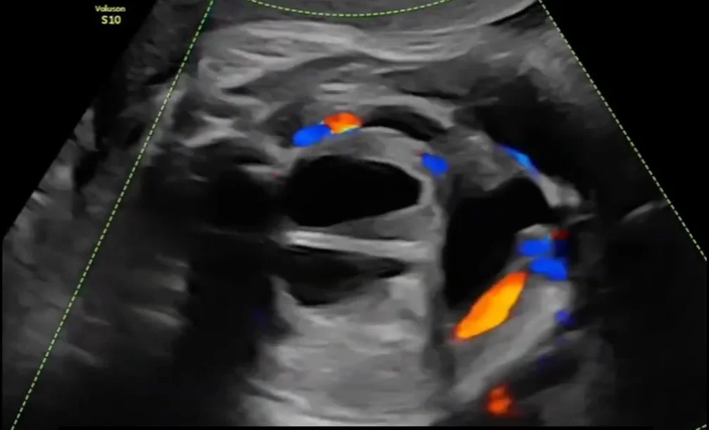 Ứ dịch âm đạo thai nhi (Hydrocolpos) / Ứ dịch âm đạo - tử cung thai nhi (Hydrometrocolpos)