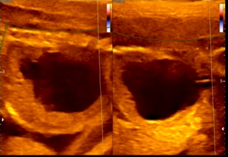 Giãn đường tiết niệu ở thai nhi (Urinary Tract Dilation)