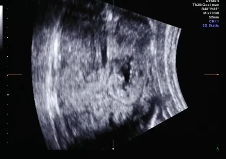 Thận tăng âm ở thai nhi (Echogenic Kidneys)