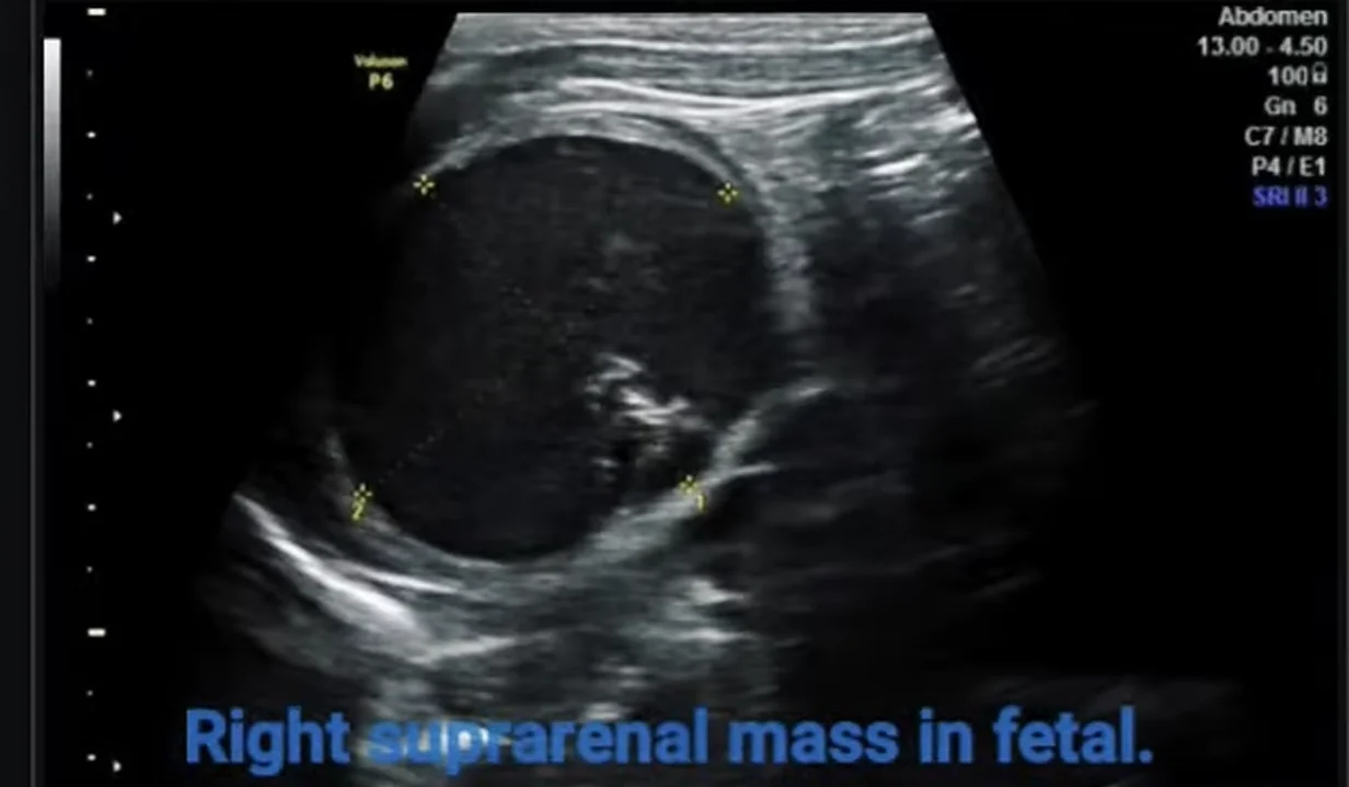 Khối u tuyến thượng thận thai nhi (Suprarenal Mass)