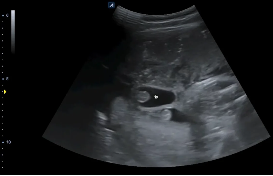 Khối ở bìu thai nhi (Fetal Scrotal Mass)