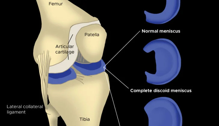 Sụn chêm hình đĩa (Discoid Meniscus)