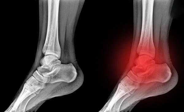 Thoái hóa khớp cổ chân (Osteoarthritis of the ankle)