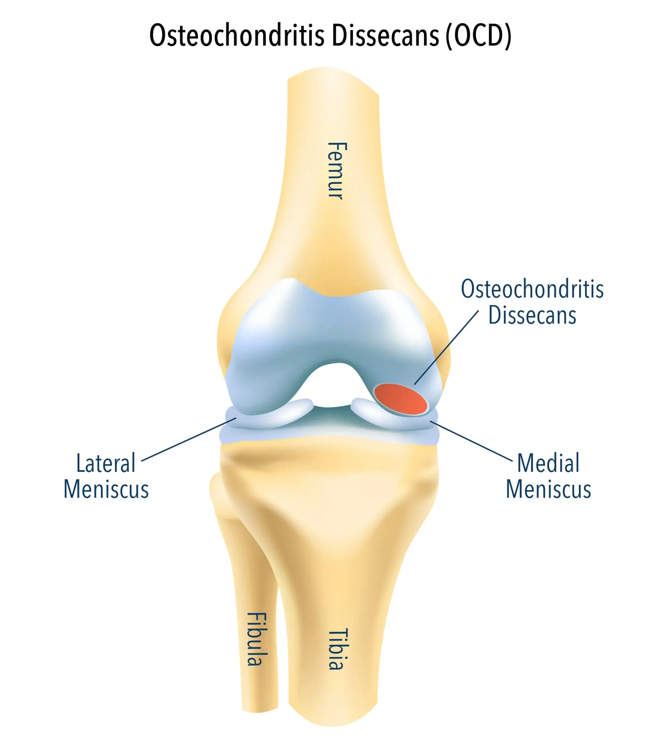 Viêm xương sụn bóc tách khớp cổ chân (Osteochondritis Dissecans of the Ankle)
