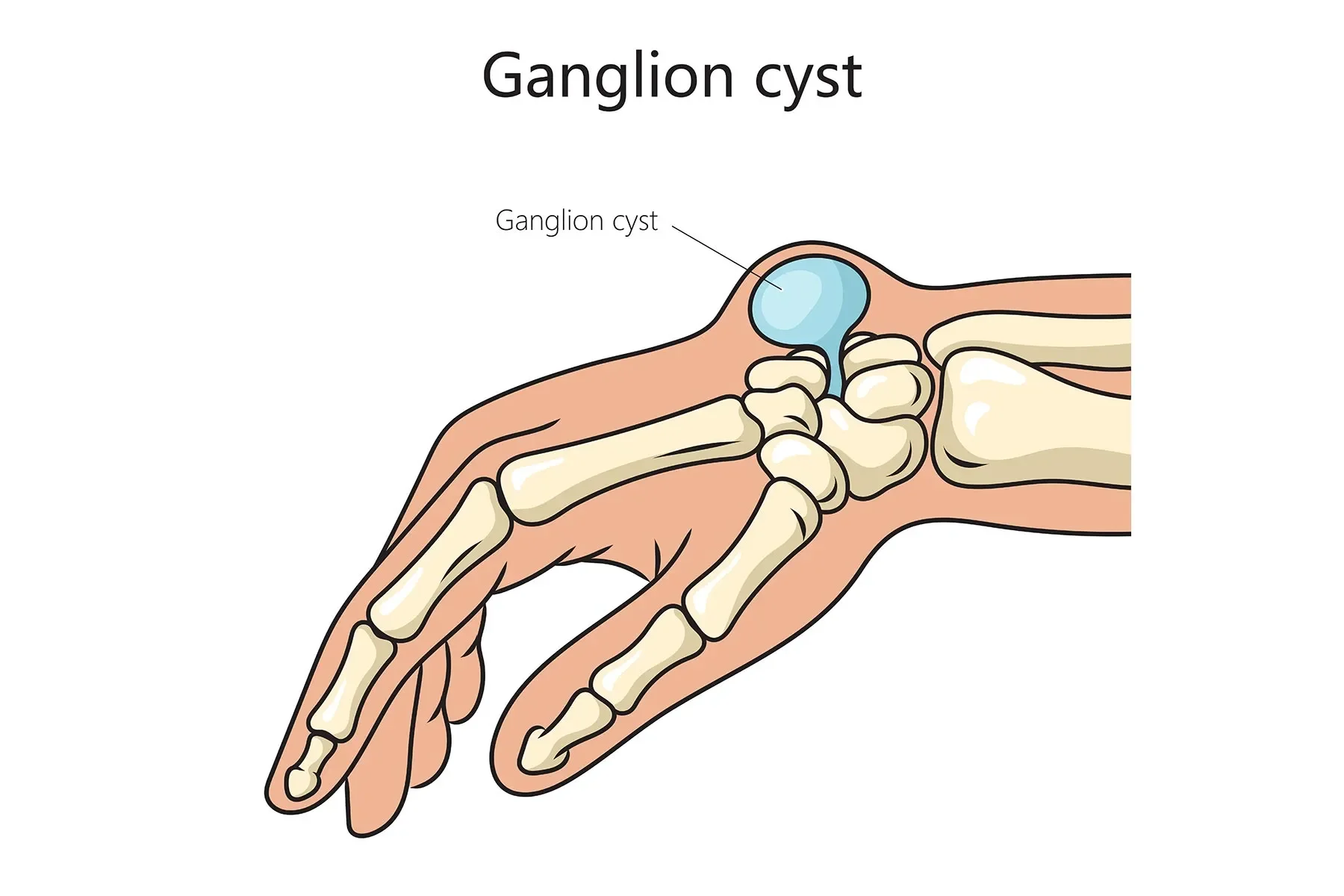 Nang hạch / Nang bao hoạt dịch (Ganglion Cyst)