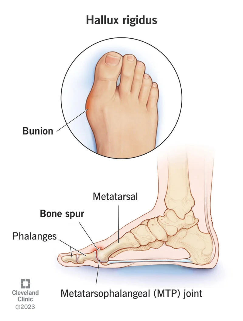 Cứng ngón chân cái (Hallux Rigidus)
