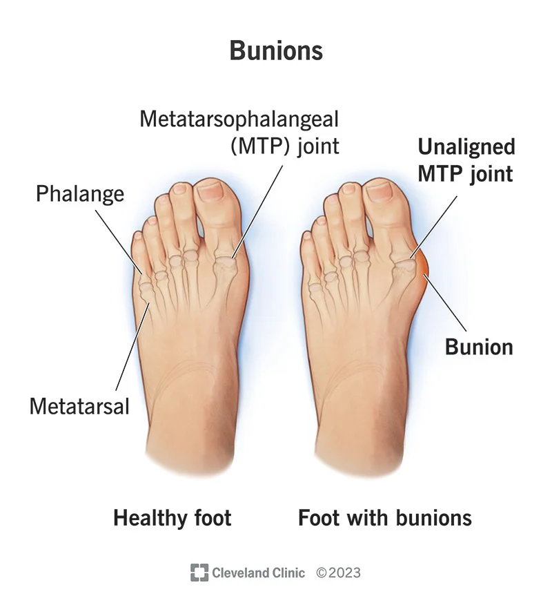 Vẹo ngón chân cái (Hallux Valgus)