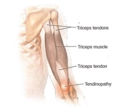 Tổn thương gân cơ tam đầu vùng khuỷu (Triceps Tendon Injury, Elbow)