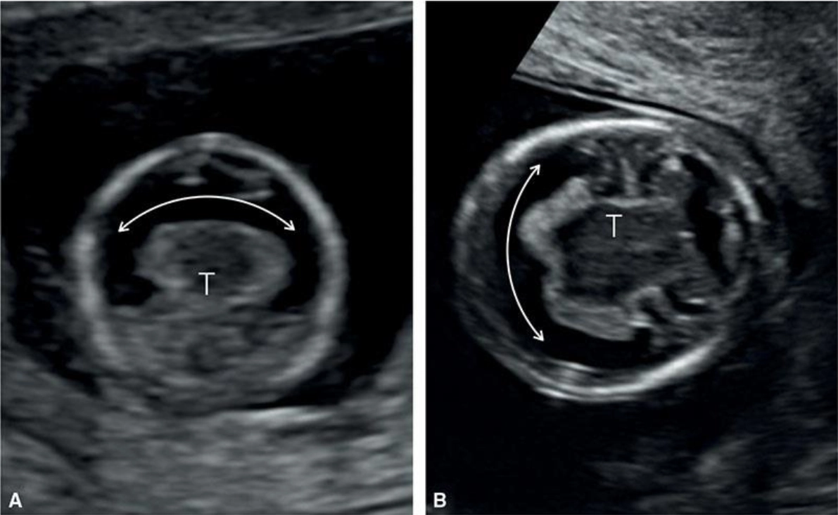 Não thất duy nhất (Holoprosencephaly-HPE)