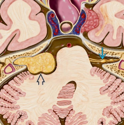 U xơ thần kinh type 2 (Neurofibromatosis type 2- NF2)