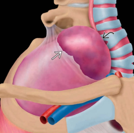 Thoát vị đỉnh phổi (Apical lung hernia)