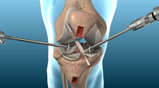 Phẫu thuật dây chằng chéo trước (Anterior cruciate ligament reconstruction)