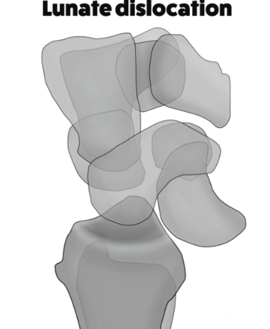 Trật xương nguyệt (Lunate dislocation)