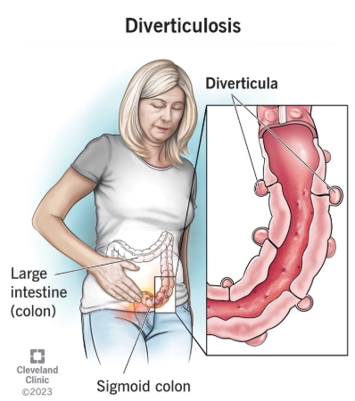 Túi thừa đại tràng (Colonic diverticulosis)