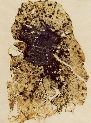 Khối xơ hóa tiến triển (Progressive massive fibrosis - PMF)