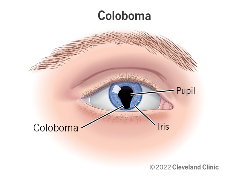 Coloboma