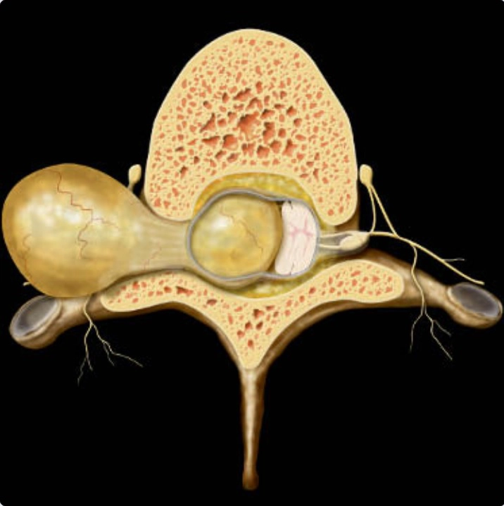 Bệnh lý trong màng cứng - ngoài tủy (Intradural extramedullary)