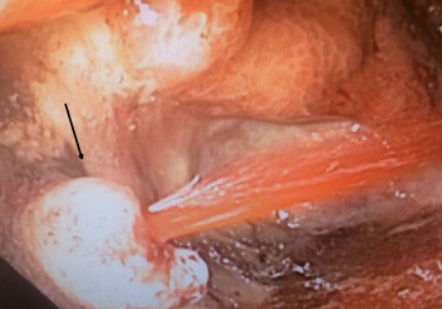 Giả phình động mạch lách (Splenic Artery Pseudoaneurysm - SAPA)