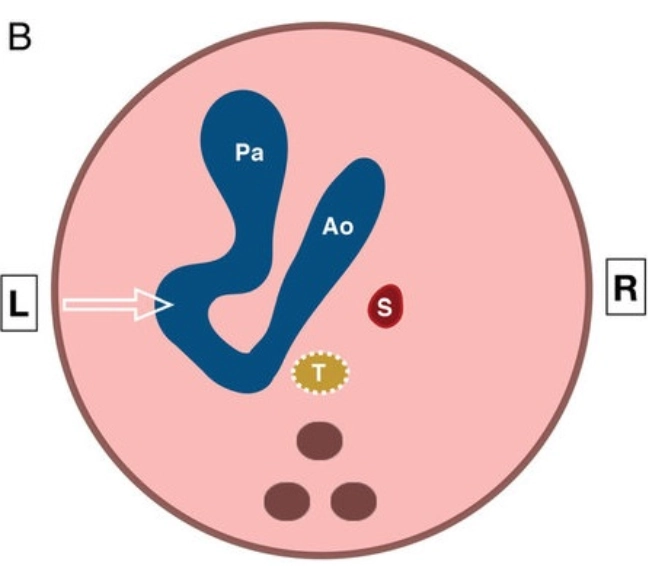 Ống động mạch hình chữ S (S-Shaped DA), gấp khúc hoặc ngoằn ngoèo