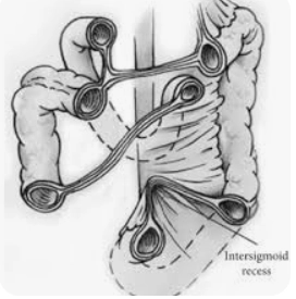 Thoát vị mạc treo đại tràng sigma (Sigmoid Mesocolon Hernia)