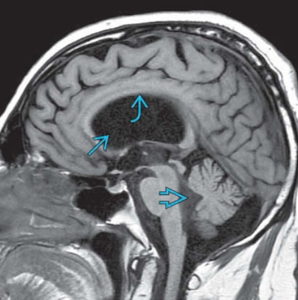 Não úng thủy áp lực bình thường (NPH - Normal-Pressure Hydrocephalus) 