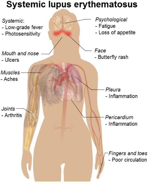 Biểu hiện cơ xương khớp ở bệnh nhân bị Lupus ban đỏ