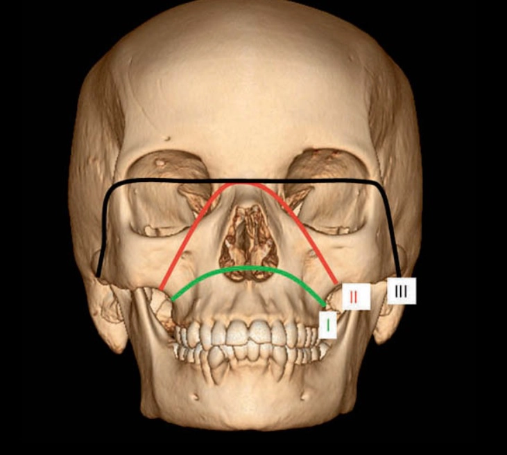 Gãy xương mặt (Facial fracture)