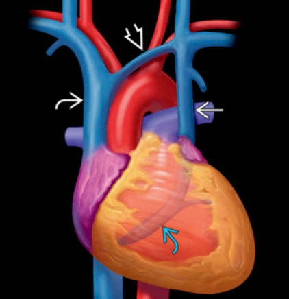 Tồn tại tĩnh mạch chủ trên trái (Persistent left superior vena cava - PLSVC)