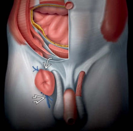 Thoát vị đùi (Femoral Hernia)