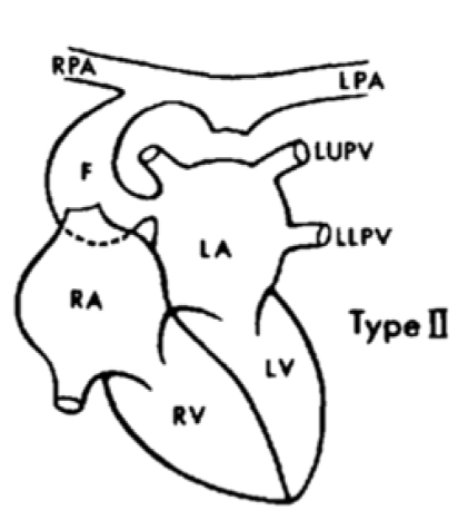 Dò động mạch phổi phải vào tâm nhĩ trái 