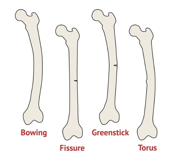 Gãy xương cẳng tay dưới ở trẻ em (Juvenile Distal Forearm Fractures)