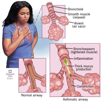 Hen suyễn (Asthma)